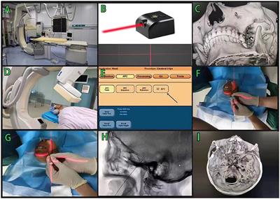 Xper-CT combined with laser-assisted navigation radiofrequency thermocoagulation in the treatment of trigeminal neuralgia